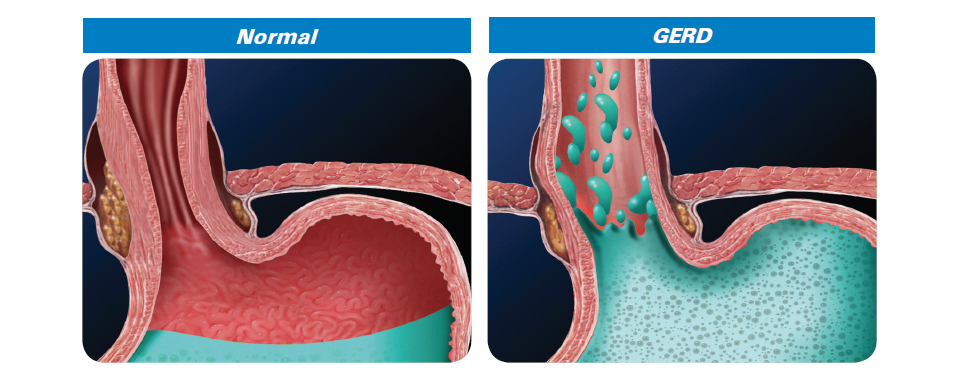 What causes GERD image