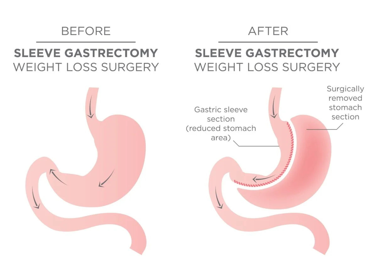 Sleeve Gastrectomy