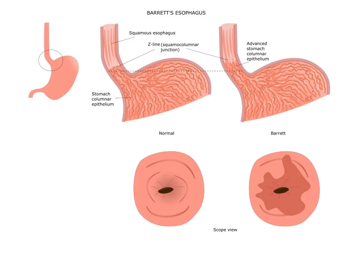 How Often Does Barrett's Esophagus Turn To Cancer Barrett's Esophagus | Garnet Health | Mid-Hudson Healthcare System