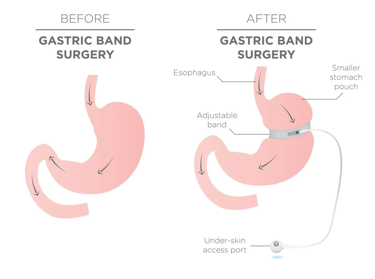 Gastric Banding