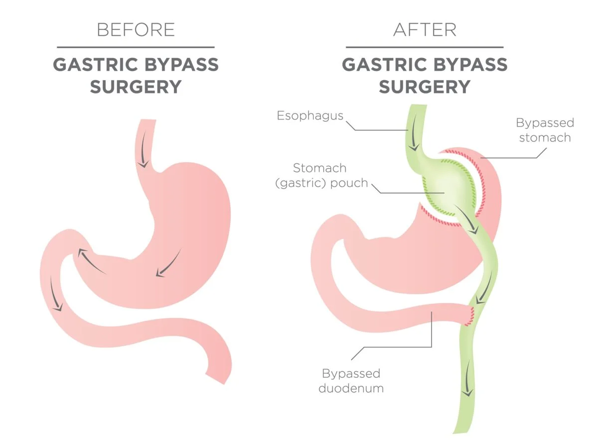 Gastric Bypass